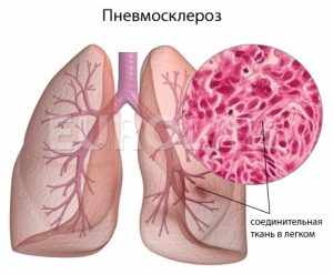 Фиброзные изменения в легких - что это?