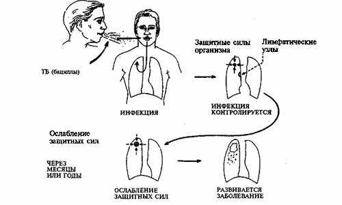Симптомы закрытой формы туберкулеза