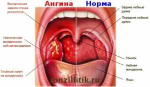 Как лечить ангину у детей?