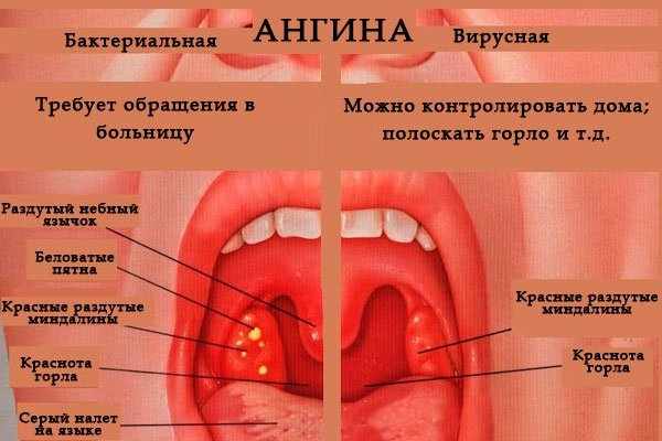 Как лечить ангину у детей?