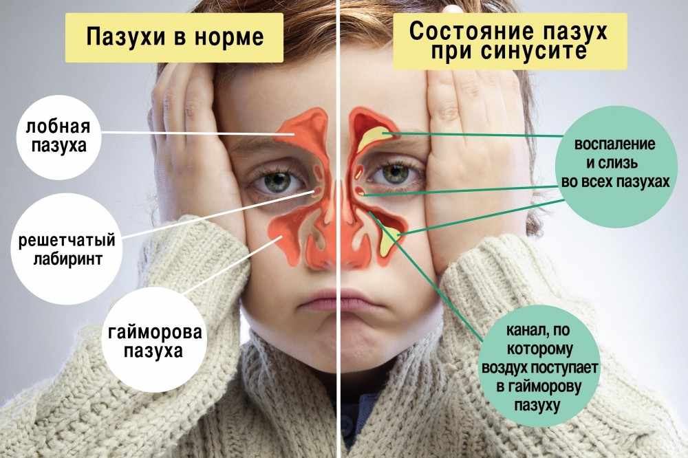 Чем синусит отличается от гайморита?