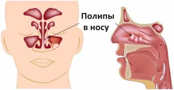 назорекс при полипах