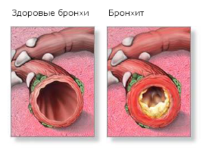Какие выбрать антибиотик при бронхите у детей?