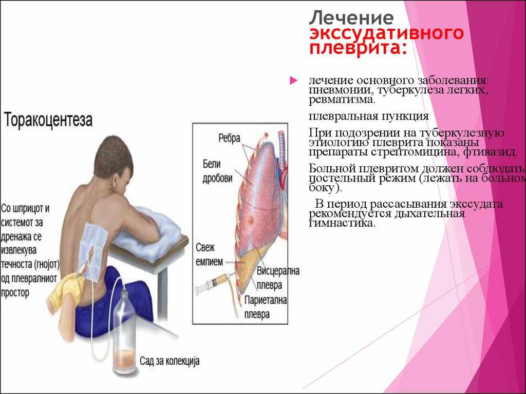 Что такое экссудативный плеврит и как лечить?