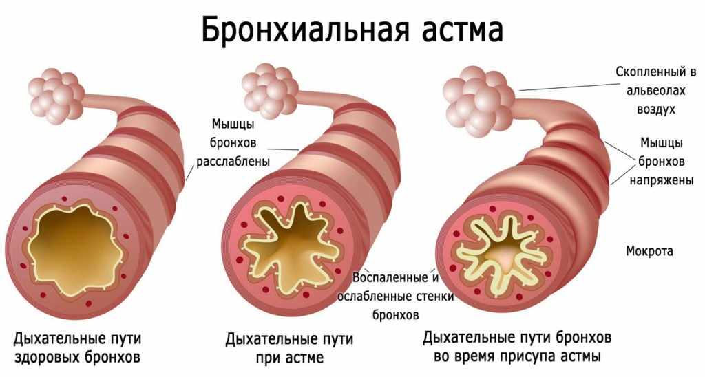 бронхиальная астма