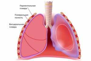 Что такое экссудативный плеврит и как лечить?