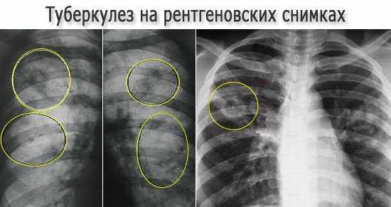 Через сколько проявляется туберкулез после заражения?