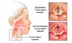 Что делать, если осип голос у взрослого?