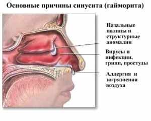 Пансинусит что это такое и как его лечить?