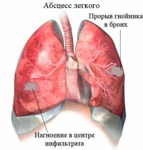 Что такое абсцесс? Классификация и лечение!