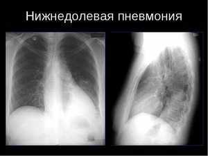 Левостороннее воспаление легких: симптомы и лечение