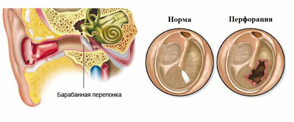 Как самостоятельно удалить ушную пробку?