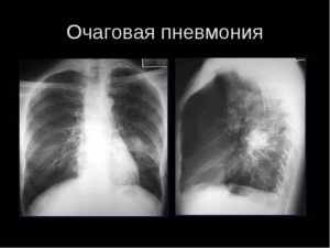 Очаговая пневмония: симптомы и лечение