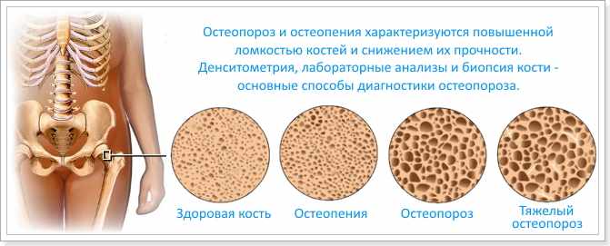 Что такое остеопороз и как его лечить?