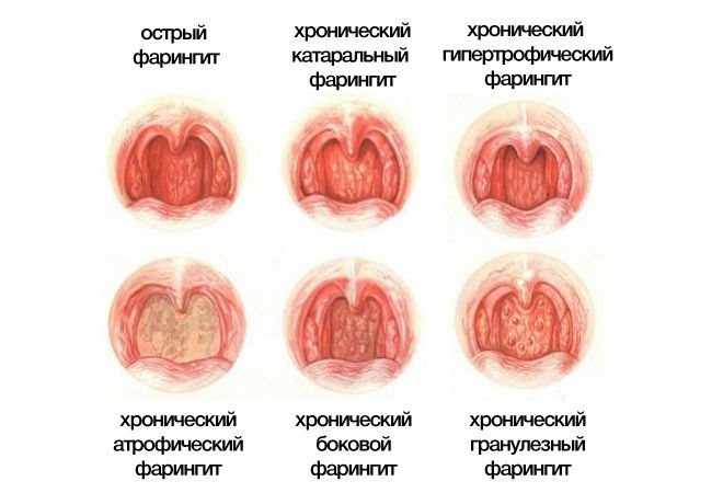 фарингит