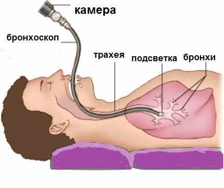 бронхоскопия легких