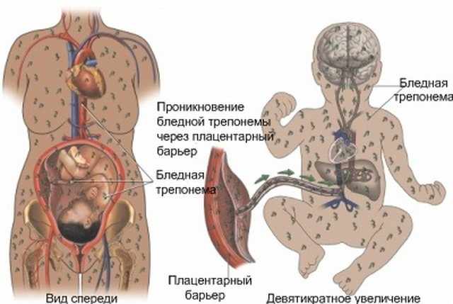 Пневмония у новорожденных кесарят