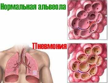 пневмония у взрослого