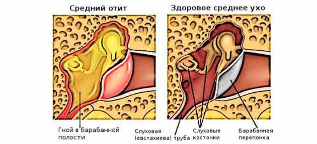 Какие антибиотики принимать при отите у взрослых?