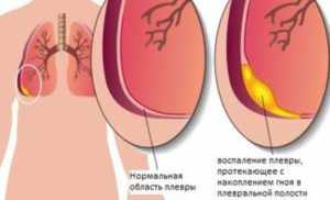 Чем опасны кальцинаты в легких?