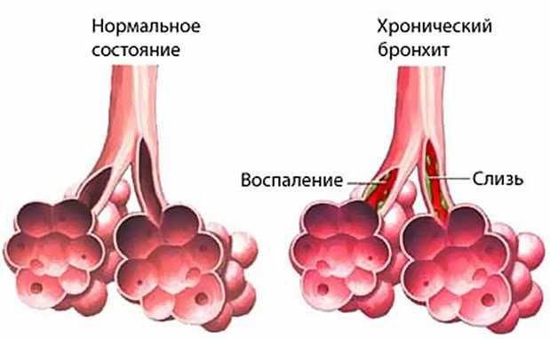Хрипы в легких без температуры с кашлем?
