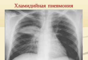 Симптомы атипичной пневмонии у взрослых и детей