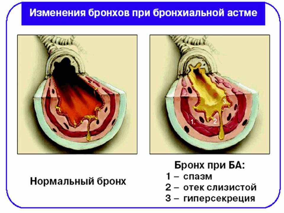 Бронхолитические средства при бронхите