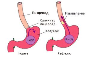 Першение в горле и сухой кашель - причины и лечение