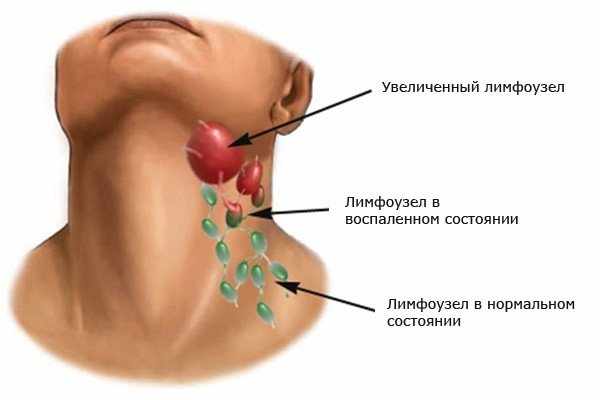 От чего увеличиваются лимфоузлы?