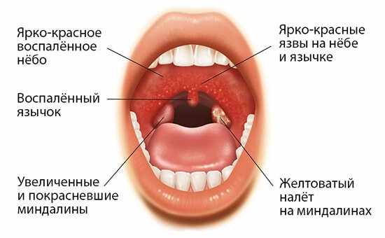 ангина