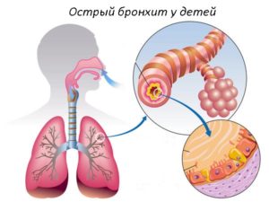 Какие выбрать антибиотик при бронхите у детей?