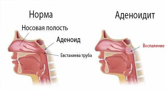 лечение насморка