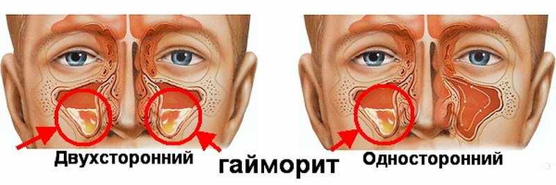 Чем синусит отличается от гайморита?