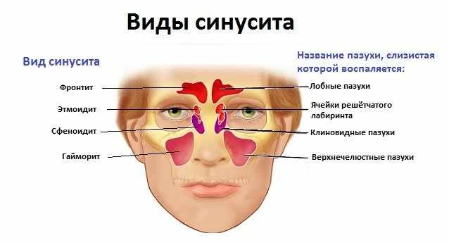 виды синусита