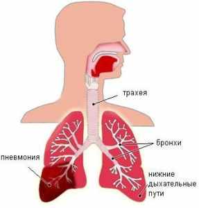 Как распознать пневмонию в домашних условиях