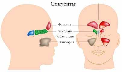 гайморит