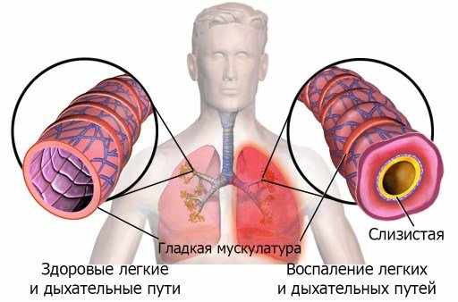 Постуральный дренаж: показания и методика проведения