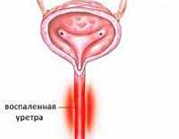 Пневмония у новорожденных кесарят