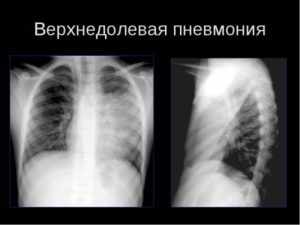 Левостороннее воспаление легких: симптомы и лечение
