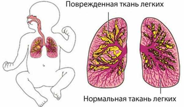 Симптомы атипичной пневмонии у взрослых и детей