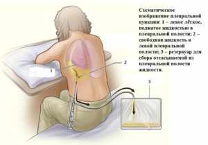 Вода в легких - симптомы и лечение