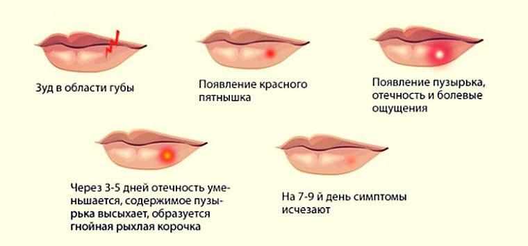 Как я победил герпес навсегда всего за 28 дней
