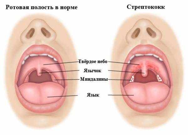 стрептококк в горле