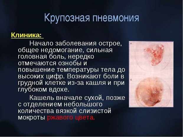 Что такое крупозная пневмония - симптомы и лечение