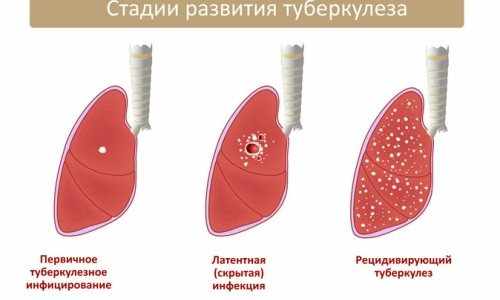 формы туберкулеза