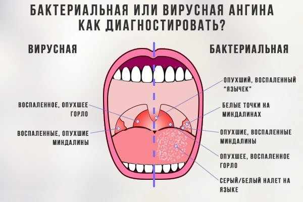 Гнойная ангина у детей - лечение в домашних условиях