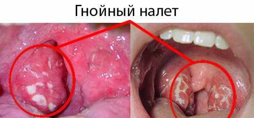 Ангина у ребенка в 2 года: симптомы и лечение