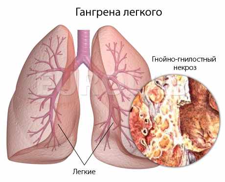 Заболевания органов дыхания и их симптомы