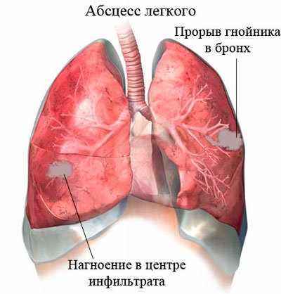 Полисегментарная пневмония: что это такое?