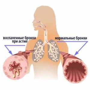 Преднизолон - все о препарате, методе воздействия и специфике использования